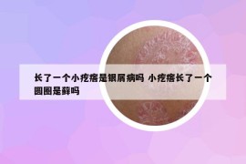 长了一个小疙瘩是银屑病吗 小疙瘩长了一个圆圈是藓吗