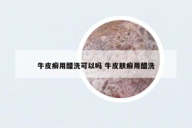 牛皮癣用醋洗可以吗 牛皮肤癣用醋洗