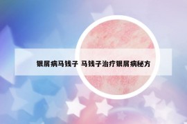 银屑病马钱子 马钱子治疗银屑病秘方