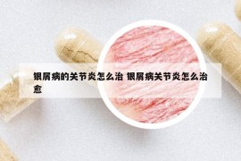 银屑病的关节炎怎么治 银屑病关节炎怎么治愈