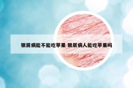 银屑病能不能吃苹果 银屑病人能吃苹果吗