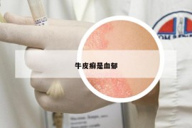 牛皮癣是血郁
