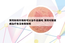 薄荷粉和珍珠粉可以治牛皮癣吗 薄荷对银屑病治疗有没有帮助呢