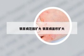 银屑病范围扩大 银屑病面积扩大