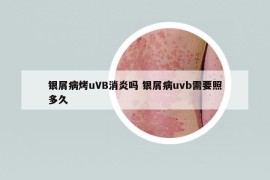 银屑病烤uVB消炎吗 银屑病uvb需要照多久