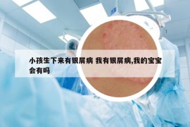 小孩生下来有银屑病 我有银屑病,我的宝宝会有吗