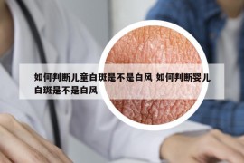 如何判断儿童白斑是不是白风 如何判断婴儿白斑是不是白风