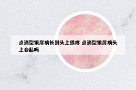 点滴型银屑病长到头上很疼 点滴型银屑病头上会起吗