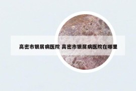 高密市银屑病医院 高密市银屑病医院在哪里