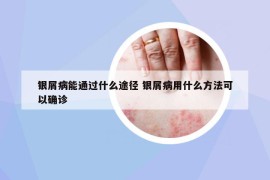 银屑病能通过什么途径 银屑病用什么方法可以确诊