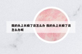 我的头上长癣了该怎么办 我的头上长癣了该怎么办呢