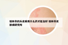 榆林市的头皮癣用什么药才能治好 榆林市皮肤病研究所
