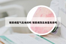 银屑病是气出来的吗 银屑病发出来是毒素吗