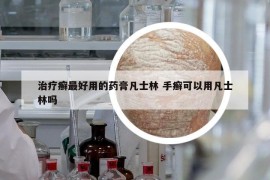 治疗癣最好用的药膏凡士林 手癣可以用凡士林吗