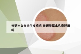 崇研小白盒治牛皮癣吗 祟研堂草本乳膏好用吗
