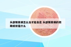 头部银屑病怎么治才能自愈 头部银屑病的初期症状是什么