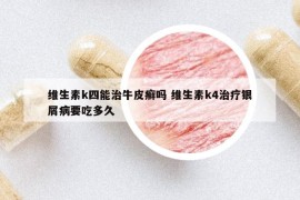 维生素k四能治牛皮癣吗 维生素k4治疗银屑病要吃多久