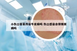 小伤口容易传染牛皮癣吗 伤口感染会得银屑病吗