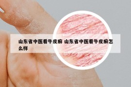 山东省中医看牛皮癣 山东省中医看牛皮癣怎么样
