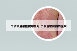 宁波银屑病医院哪里好 宁波治银屑病的医院