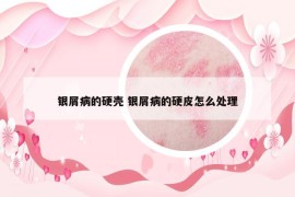 银屑病的硬壳 银屑病的硬皮怎么处理