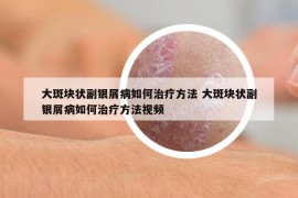 大斑块状副银屑病如何治疗方法 大斑块状副银屑病如何治疗方法视频