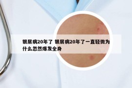银屑病20年了 银屑病20年了一直轻微为什么忽然爆发全身