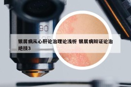 银屑病从心肝论治理论浅析 银屑病辩证论治绝技3