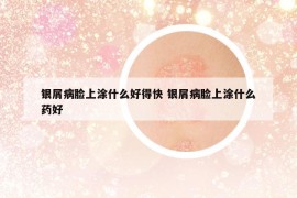 银屑病脸上涂什么好得快 银屑病脸上涂什么药好