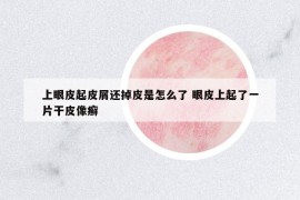上眼皮起皮屑还掉皮是怎么了 眼皮上起了一片干皮像癣