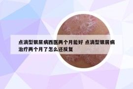 点滴型银屑病西医两个月能好 点滴型银屑病治疗两个月了怎么还反复