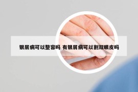 银屑病可以整容吗 有银屑病可以割双眼皮吗