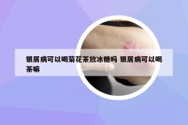 银屑病可以喝菊花茶放冰糖吗 银屑病可以喝茶嘛
