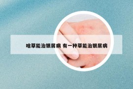 啥草能治银屑病 有一种草能治银屑病