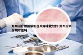 郑州治疗银屑病的医院哪家比较好 郑州治银屑病可靠吗