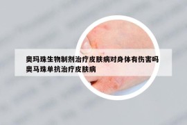 奥玛珠生物制剂治疗皮肤病对身体有伤害吗 奥马珠单抗治疗皮肤病