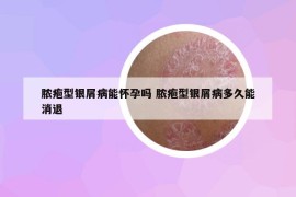 脓疱型银屑病能怀孕吗 脓疱型银屑病多久能消退