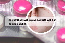 牛皮癣那块地方的皮去掉 牛皮癣那块地方的皮去掉了怎么办