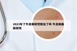 2023年了牛皮癣研究根治了吗 牛皮癣最新研究