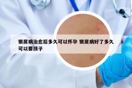 银屑病治愈后多久可以怀孕 银屑病好了多久可以要孩子