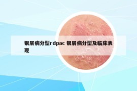 银屑病分型rdpac 银屑病分型及临床表现
