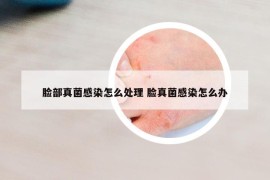 脸部真菌感染怎么处理 脸真菌感染怎么办