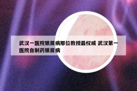 武汉一医院银屑病那位教授最权威 武汉第一医院自制药银屑病