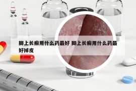 脚上长癣用什么药最好 脚上长癣用什么药最好掉皮