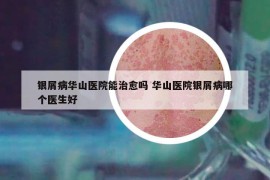 银屑病华山医院能治愈吗 华山医院银屑病哪个医生好