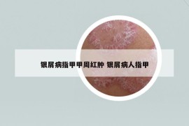 银屑病指甲甲周红肿 银屑病人指甲
