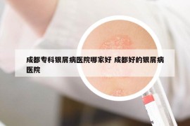 成都专科银屑病医院哪家好 成都好的银屑病医院
