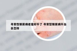 寻常性银屑病老是好不了 寻常型银屑病不治会怎样