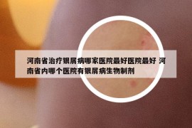 河南省治疗银屑病哪家医院最好医院最好 河南省内哪个医院有银屑病生物制剂