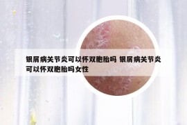 银屑病关节炎可以怀双胞胎吗 银屑病关节炎可以怀双胞胎吗女性